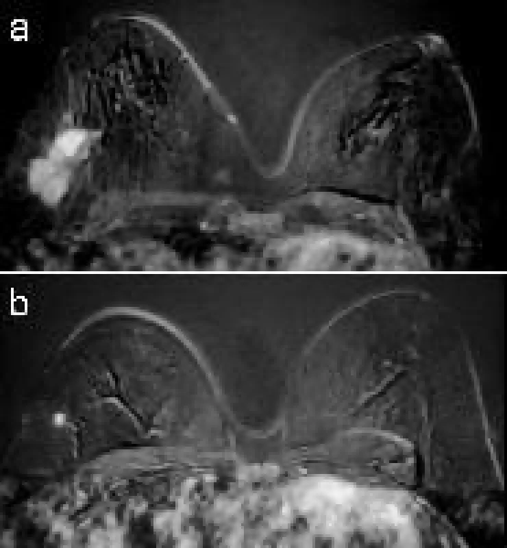 Brustkrebspatientin unter neoadjuvanter (präoperativer) Chemotherapie. Das MRT zeigt deutlich, wie der bösartige Tumor (im Bild weiß) unter der Chemotherapie schrumpft.