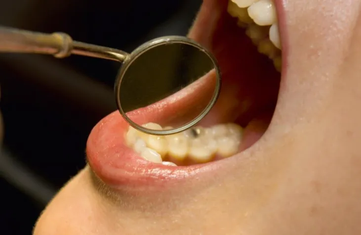 Bild: Professionelle Zahnreinigung